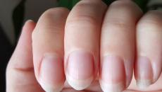 Болезни ногтей с изменением цвета